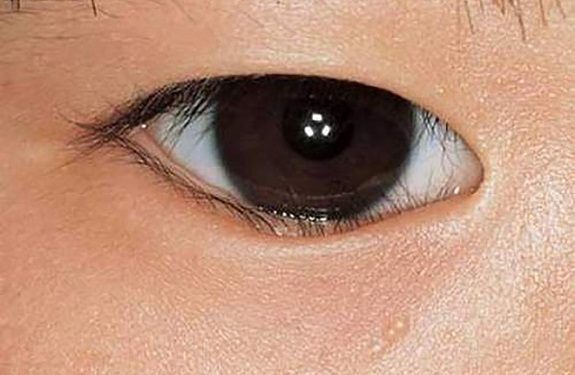QUẶM MI BẨM SINH: TRIỆU CHỨNG VÀ PHƯƠNG PHÁP ĐIỀU TRỊ