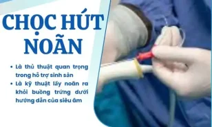 CHỌC HÚT TRỨNG VÀ NHỮNG ĐIỀU CẦN LƯU Ý.