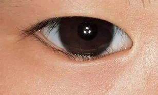 QUẶM MI BẨM SINH: TRIỆU CHỨNG VÀ PHƯƠNG PHÁP ĐIỀU TRỊ