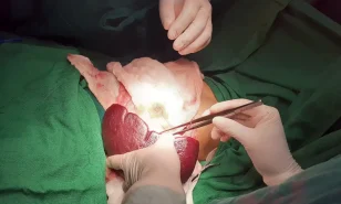 PHẪU THUẬT CẮT LÁCH CHO BỆNH NHI 3 TUỔI BỊ THALASSEMIA