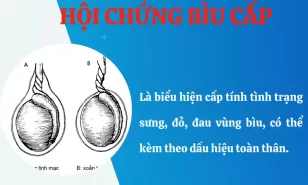Hội chứng bìu cấp