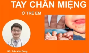 Bệnh tay chân miệng (hfmd)