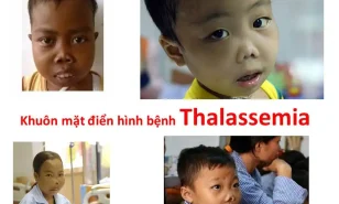 THIẾU MÁU HUYẾT TÁN (THALASSEMIA)