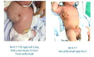 Bệnh viện Sản Nhi Vĩnh Phúc phẫu thuật thành công cắt khối u bẩm sinh “khổng lồ” vùng ngực cho trẻ sơ sinh 02 ngày tuổi