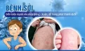 5 khuyến cáo của bộ y tế về phòng, chống dịch bệnh sởi