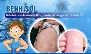 5 khuyến cáo của bộ y tế về phòng, chống dịch bệnh sởi