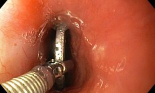 Nội soi can thiệp gắp dị vật ống tiêu hóa thành công cho bệnh nhi 4 tuổi
