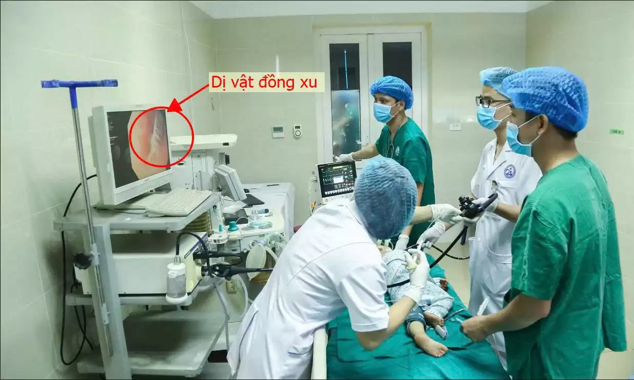 Nội soi gắp dị vật đường tiêu hóa