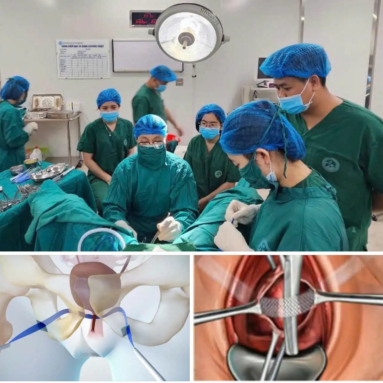Phẫu thuật TOT trên người bệnh Són tiểu.