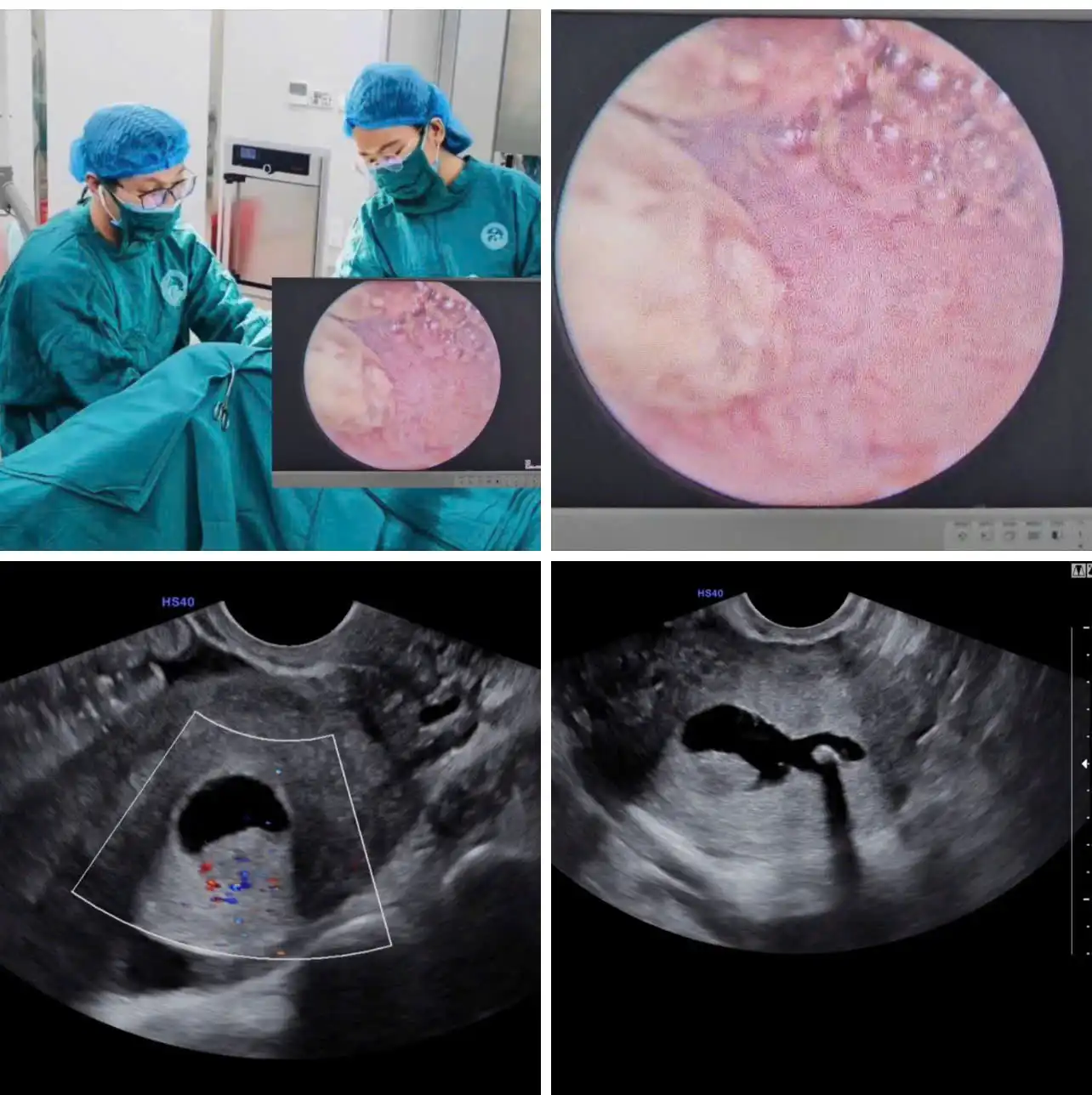Phẫu thuật điều trị Polyp buồng tử cung.