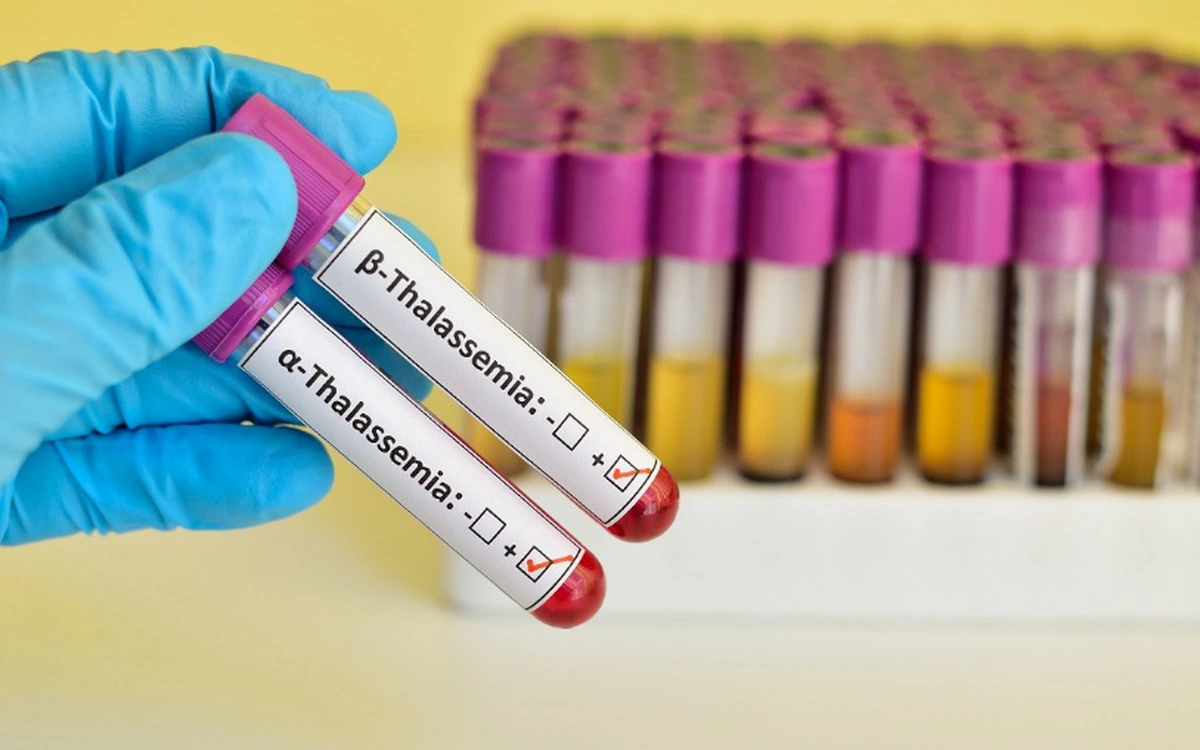 Xét nghiệm phát hiện bệnh Thalassemia