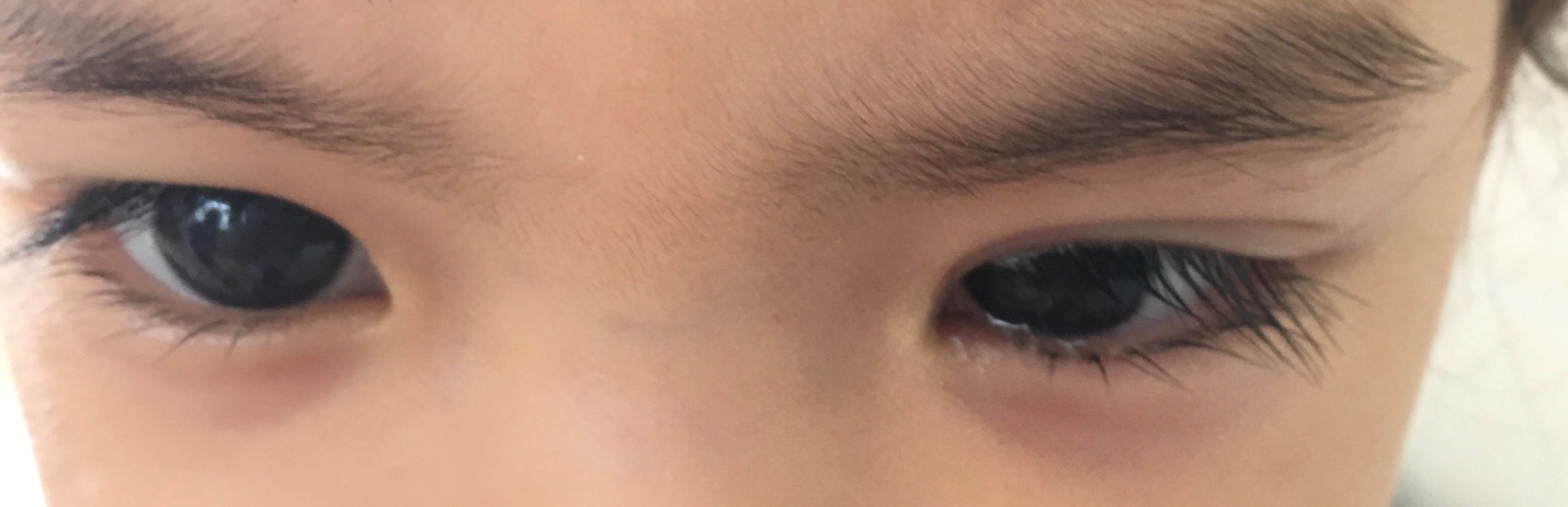 BỎNG MẮT DO CHỌC ĐIẾU THUỐC LÁ ĐANG CHÁY VÀO MẮT