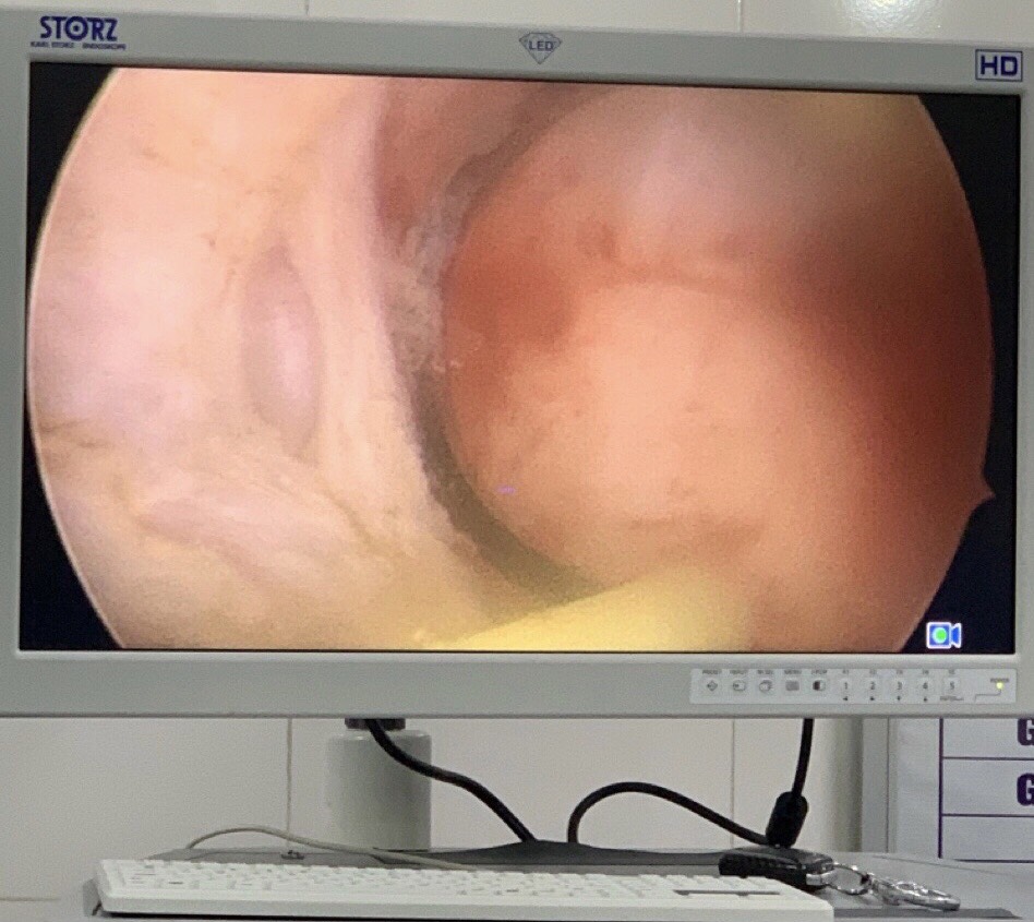 KHUYẾT SẸO MỔ LẤY THAI