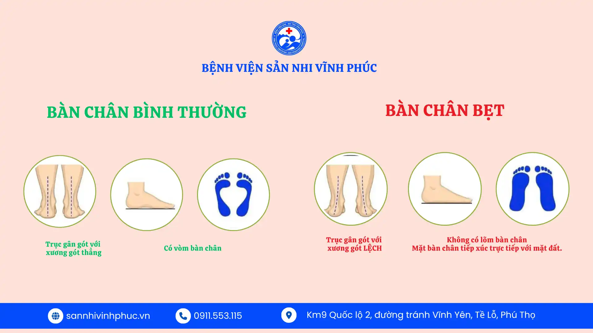 Bàn chân bẹt ở trẻ em: Nguyên nhân và Tác hại cha mẹ không nên bỏ qua. 1 Bàn chân bẹt và bàn chân bình thường.