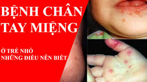 Chủ động phòng, chống bệnh tay chân miệng đầu năm học mới