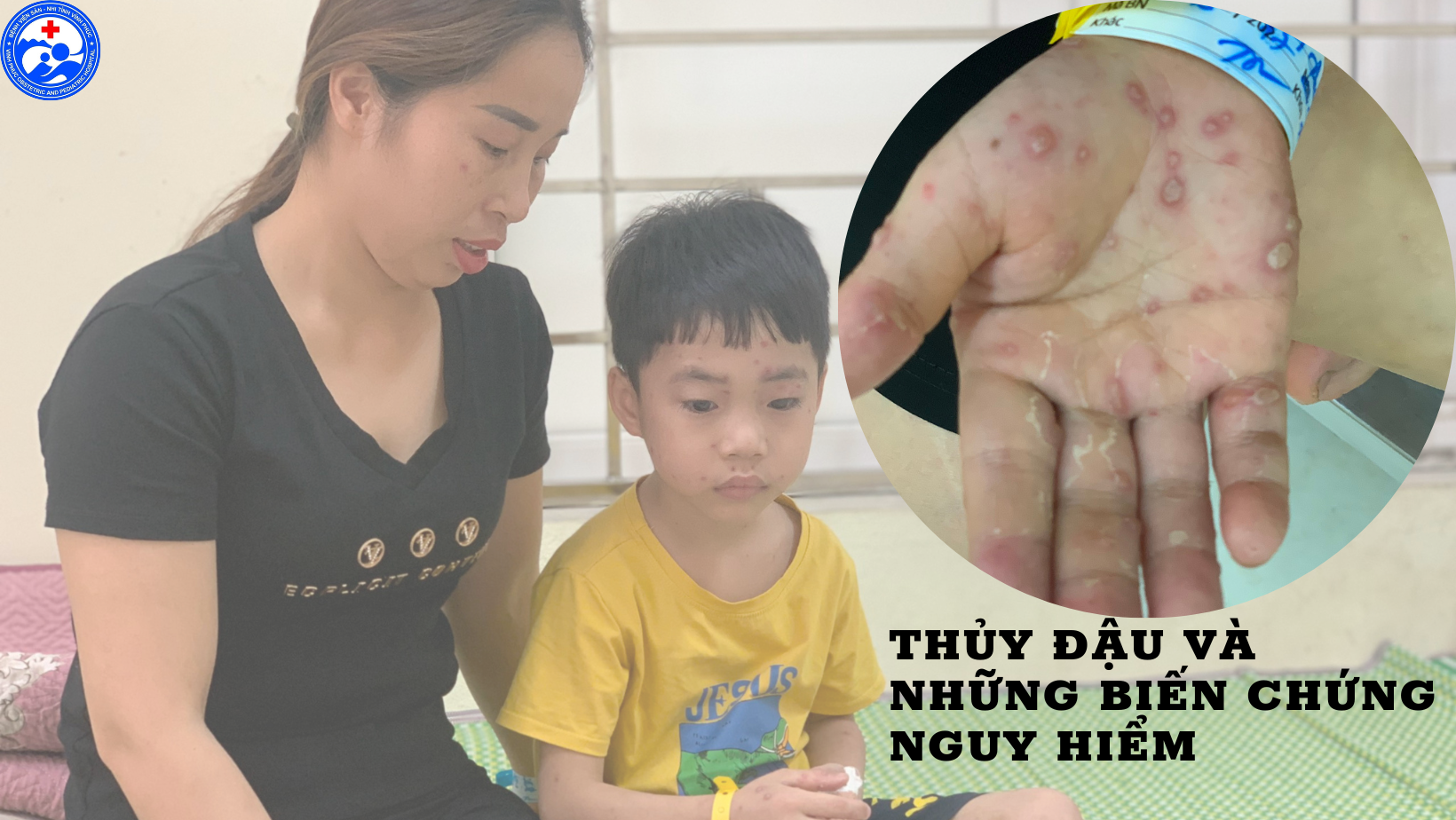 BỆNH THỦY ĐẬU VÀ NHỮNG BIẾN CHỨNG NGUY HIỂM