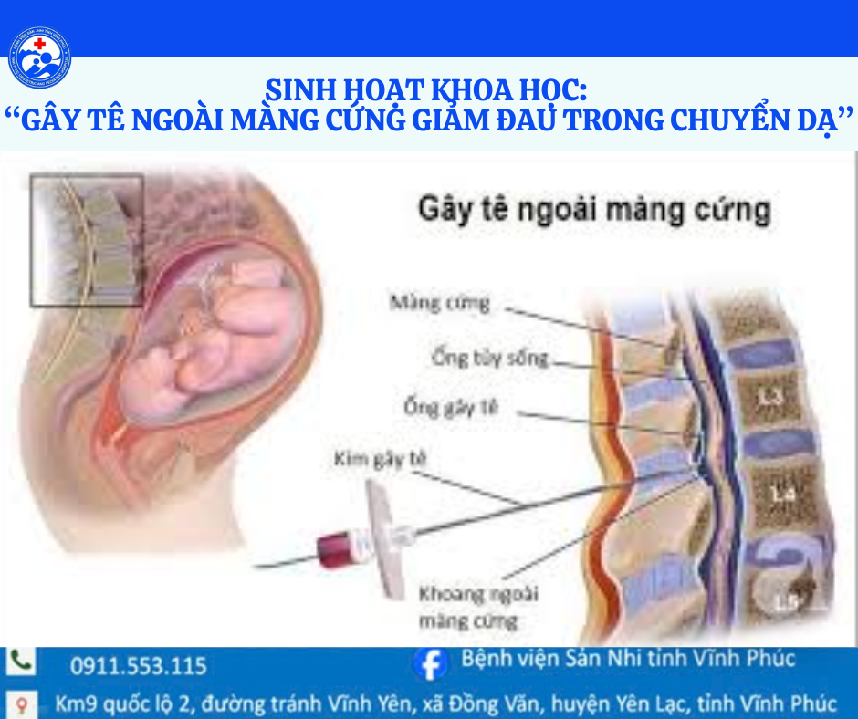 SINH HOẠT KHOA HỌC: GÂY TÊ NGOÀI MÀNG CỨNG GIẢM ĐAU TRONG CHUYỂN DẠ