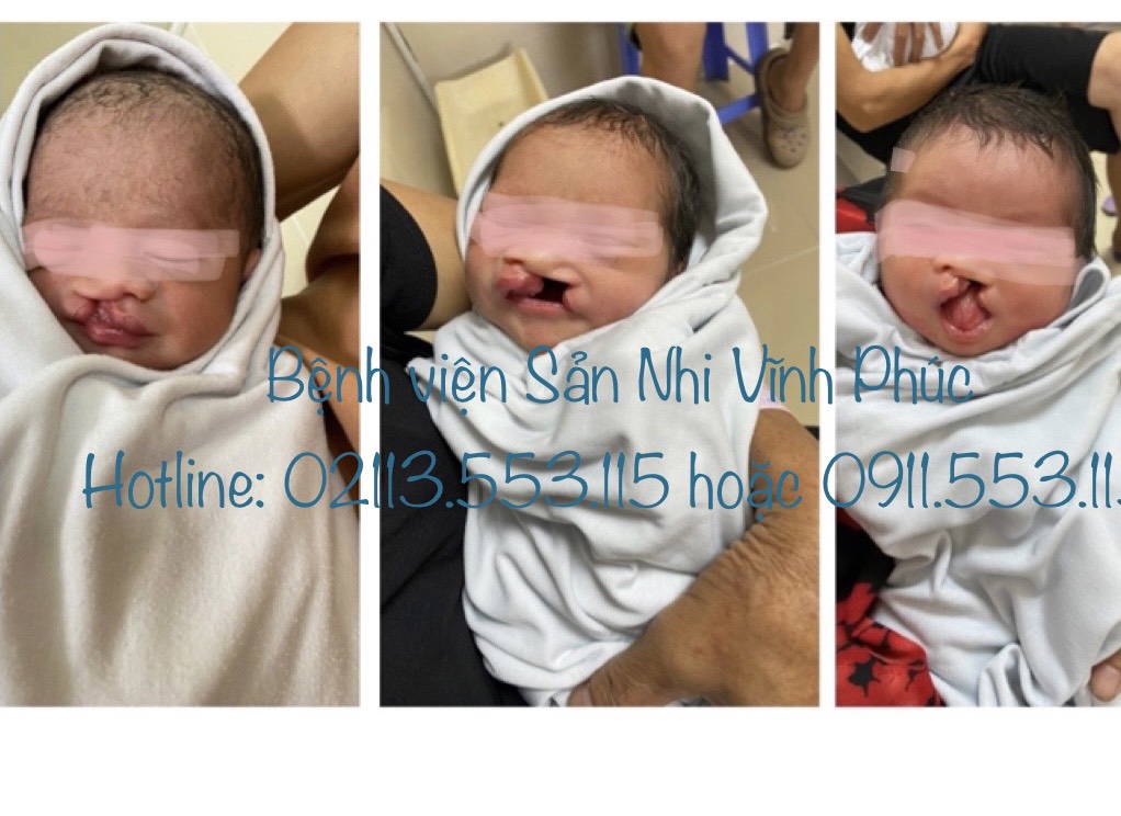 Điều trị toàn diện cho trẻ khe hở môi – vòm miệng