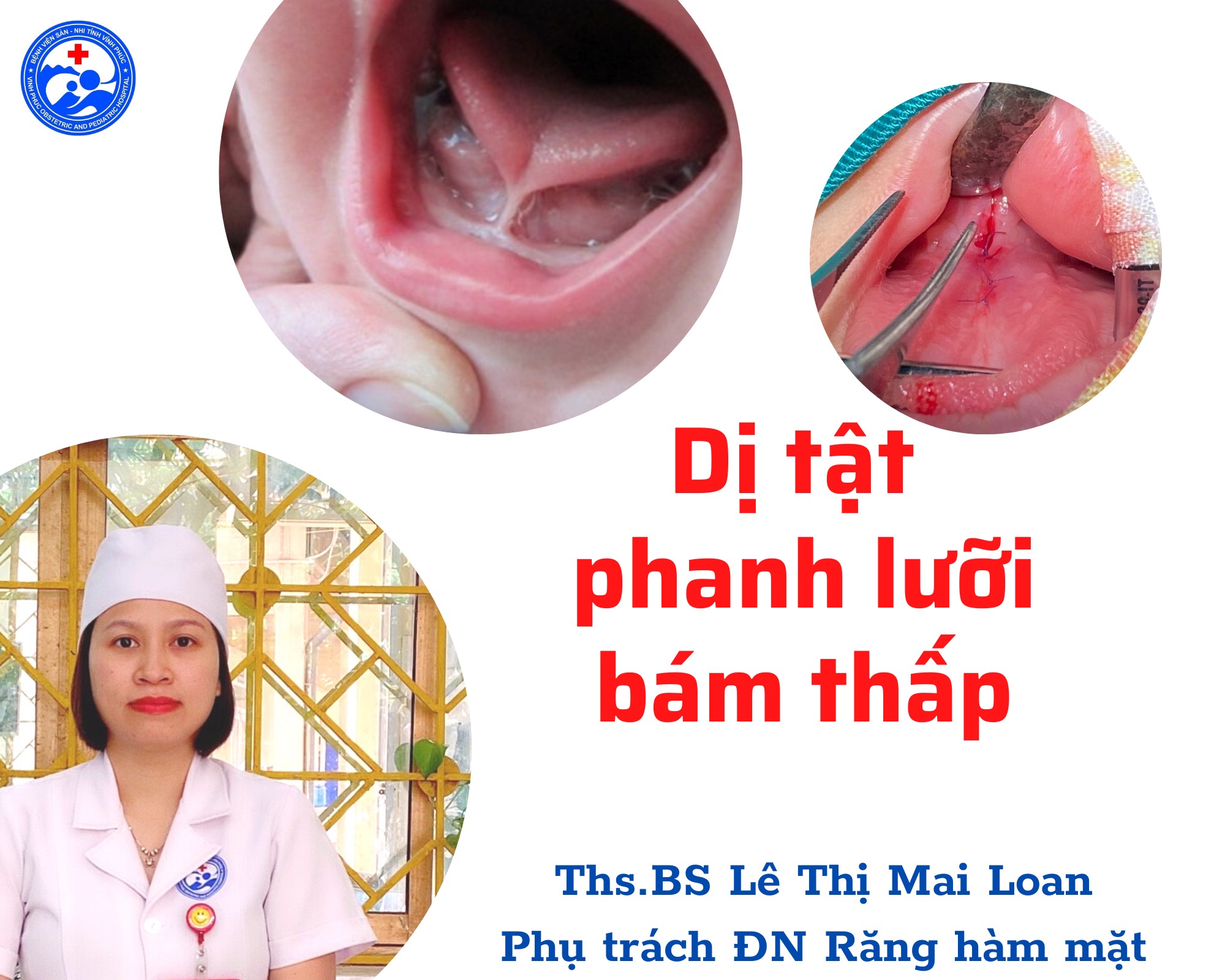 TẠI SAO CẦN PHÁT HIỆN, ĐIỀU TRỊ SỚM DỊ TẬT PHANH LƯỠI BÁM THẤP Ở TRẺ EM