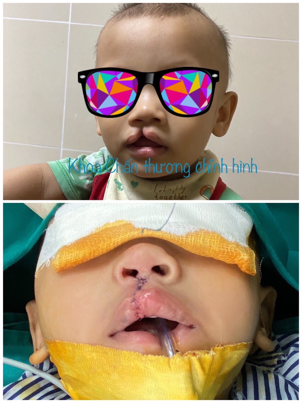 PHẪU THUẬT TẠO HÌNH KHE HỞ MÔI – VÒM MIỆNG CHO TRẺ 9th và 13th TUỔI