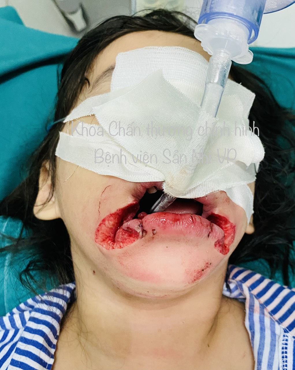 CẢNH BÁO: DẤU TÍCH BUỒN TRÊN MẶT TRẺ THƠ VÌ MỘT PHÚT LƠ LÀ CỦA NGƯỜI LỚN