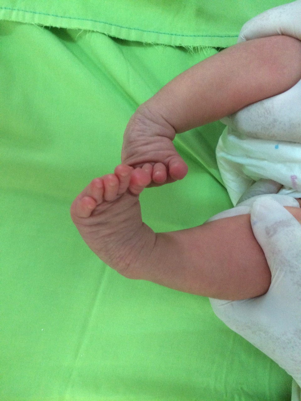 Hãy để bác sĩ chuyên khoa chỉnh hình nắn chỉnh BÀN CHÂN KHOÈO của bé sớm nhất để bé được vận động bình thường và dáng đi tự tin