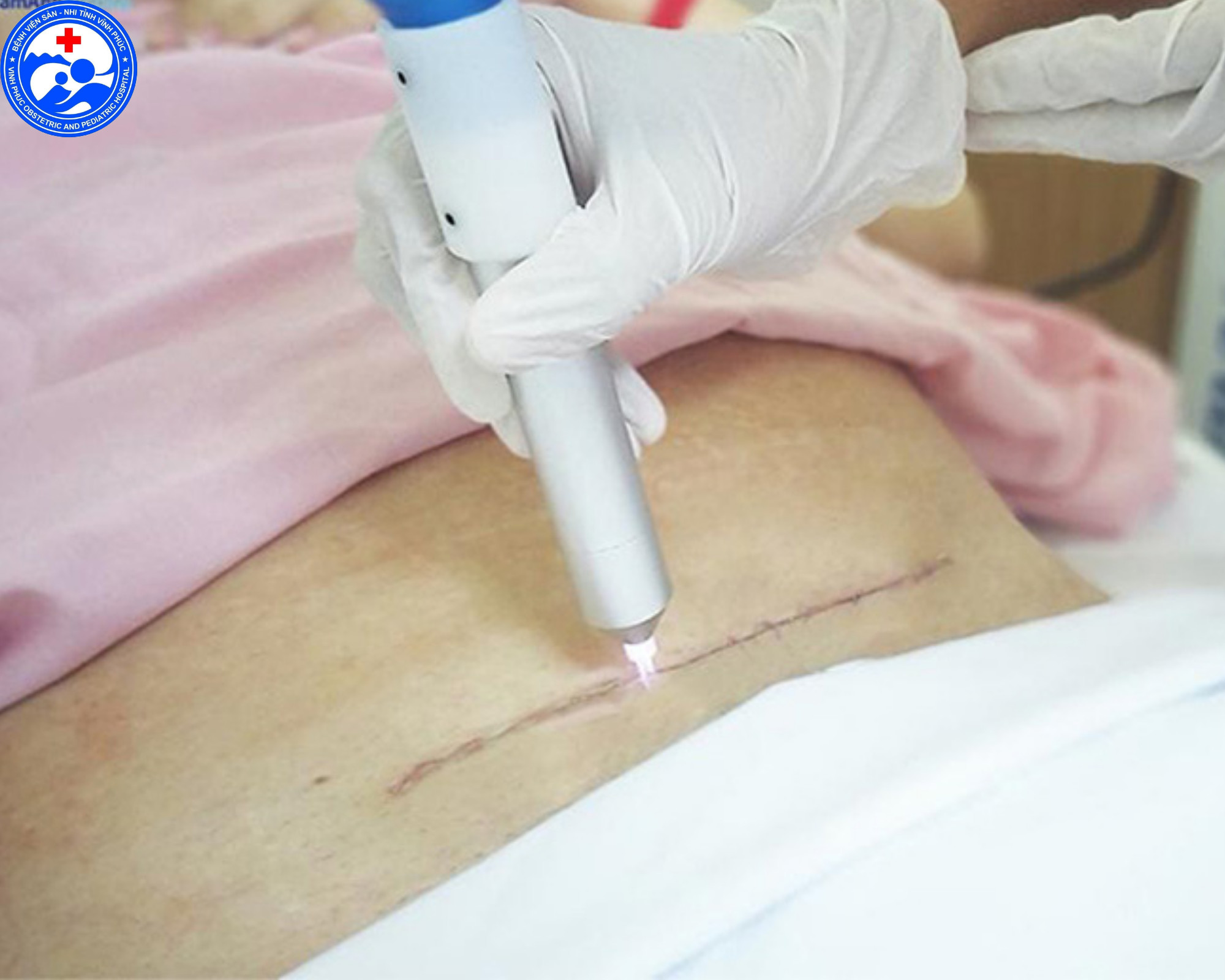 SAU SINH NHẤT ĐỊNH NÊN CHIẾU TIA PLASMA
