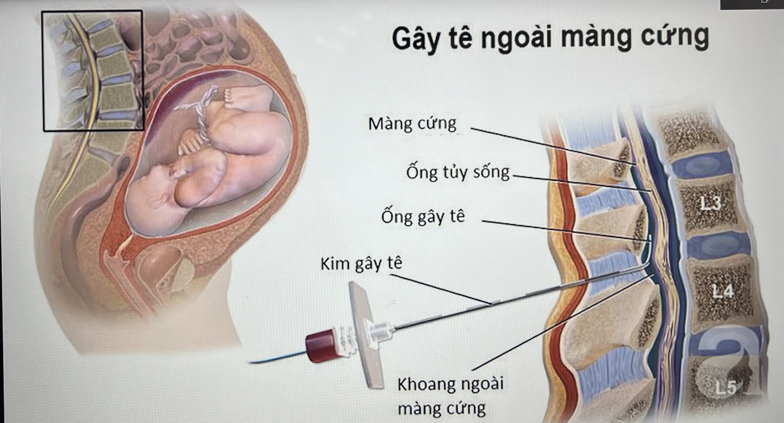TRẢI NGHIỆM DỊCH VỤ “GIẢM ĐAU TRONG ĐẺ” TẠI BỆNH VIỆN SẢN NHI VĨNH PHÚC