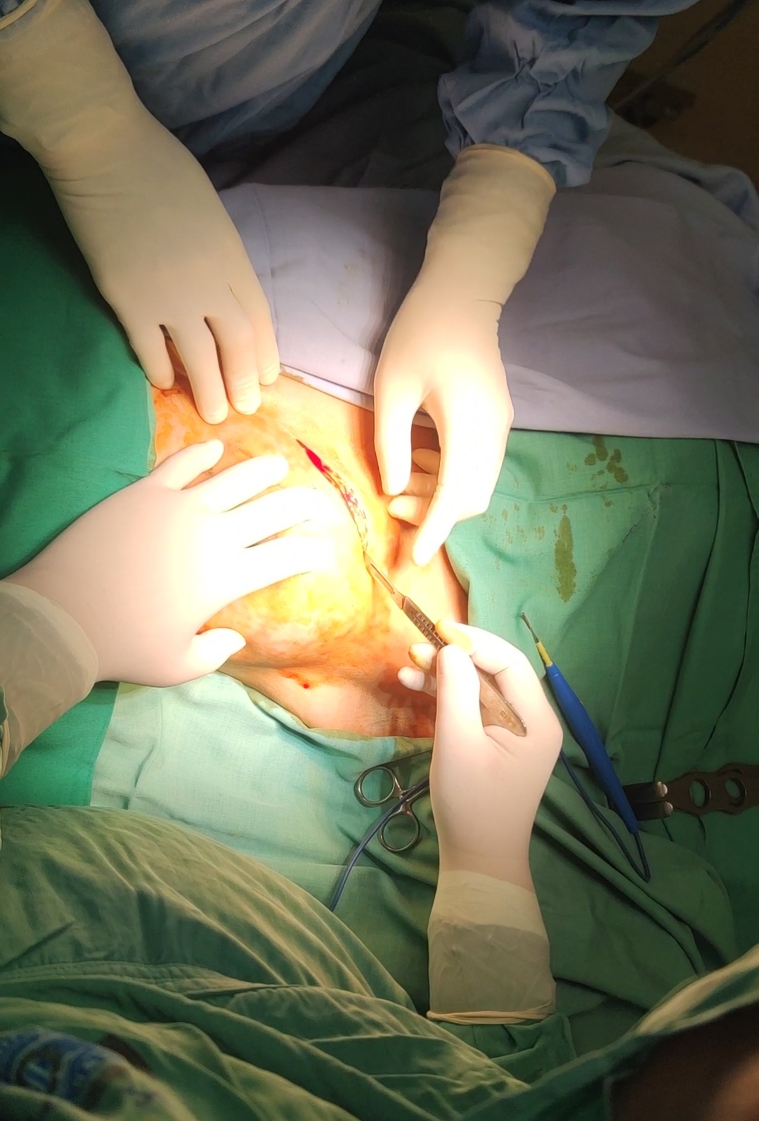 BỆNH VIỆN SẢN NHI VĨNH PHÚC PHẪU THUẬT THÀNH CÔNG  BỆNH NHÂN UNG THƯ VÚ