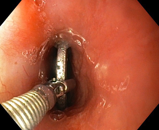 NỘI SOI CAN THIỆP GẮP DỊ VẬT ỐNG TIÊU HÓA THÀNH CÔNG CHO BỆNH NHI 4 TUỔI