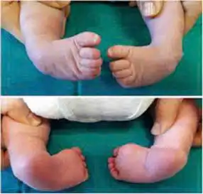 Bàn chân thuổng - Phát hiện sớm, điều trị kịp thời. 2 Hình ảnh bàn chân thuổng.