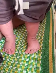 Bàn chân thuổng - Phát hiện sớm, điều trị kịp thời. 1 HA2