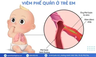 VIÊM PHẾ QUẢN Ở TRẺ EM – NGUYÊN NHÂN, CHẨN ĐOÁN VÀ ĐIỀU TRỊ
