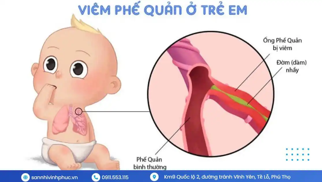 Viêm phế quản ở trẻ em..