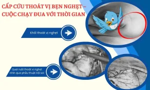 Thoát Vị Bẹn Nghẹt Ở Trẻ Em: Biến Chứng Cấp Cứu Ngoại Khoa