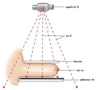 Chụp XQuang tuyến vú (Nguồn ảnh Bộ y tế)