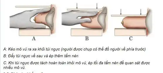 Chụp XQuang tuyến vú ở phụ nữ có đặt túi ngực (Nguồn ảnh Bộ y tế)
