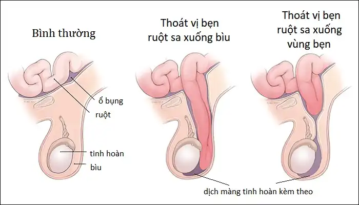 Thoát vị bẹn ở trẻ em (hình ảnh minh họa)