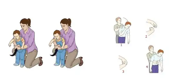 Hóc Dị vật đường thở ở trẻ em: Nhận biết sớm – Sơ cứu đúng – Phòng tránh hiệu quả 3 Cấp cứu hóc dị vật (Thủ thuật Heimlich)