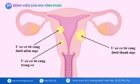 U xơ cơ tử cung: Nguyên nhân, triệu chứng, phân loại và giải pháp hiệu quả