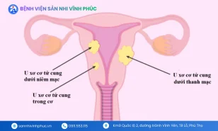 U xơ cơ tử cung: Nguyên nhân, triệu chứng, phân loại và giải pháp hiệu quả
