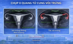 Chụp X-quang tử cung vòi trứng là gì? Khi nào cần thực hiện?