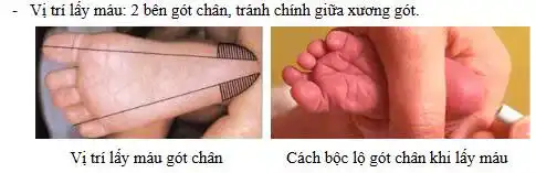 Lấy máu gót chân sơ sinh: Xét nghiệm quan trọng giúp phát hiện sớm bệnh lý bẩm sinh 1 Vị trí lấy máu gót chân