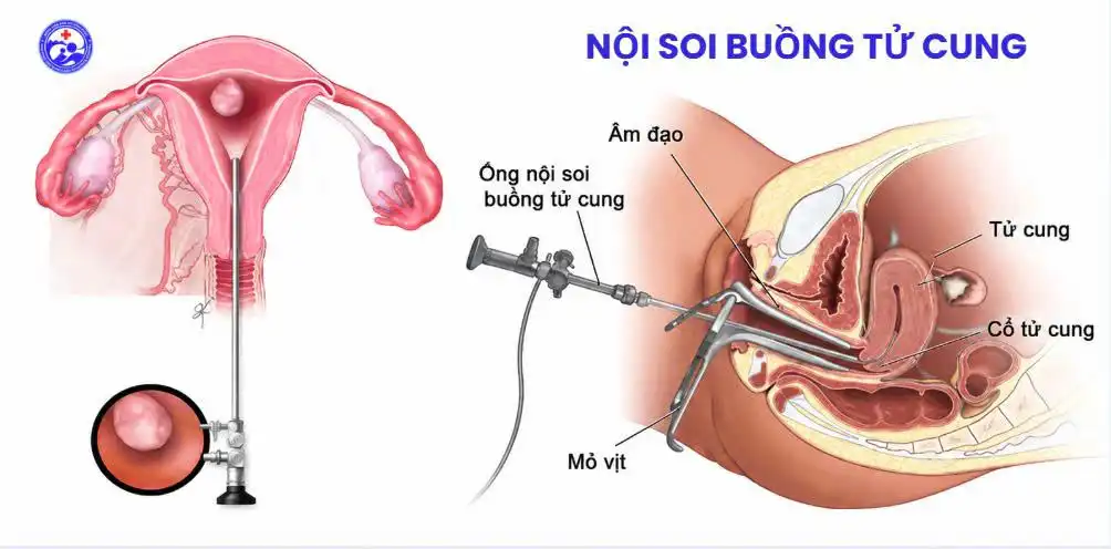 Nội soi buồng tử cung trước chuyển phôi IVF - Bước đánh giá quan trọng giúp tối ưu cơ hội thành công 1 Nội soi buồng tử cung (Ảnh minh họa)