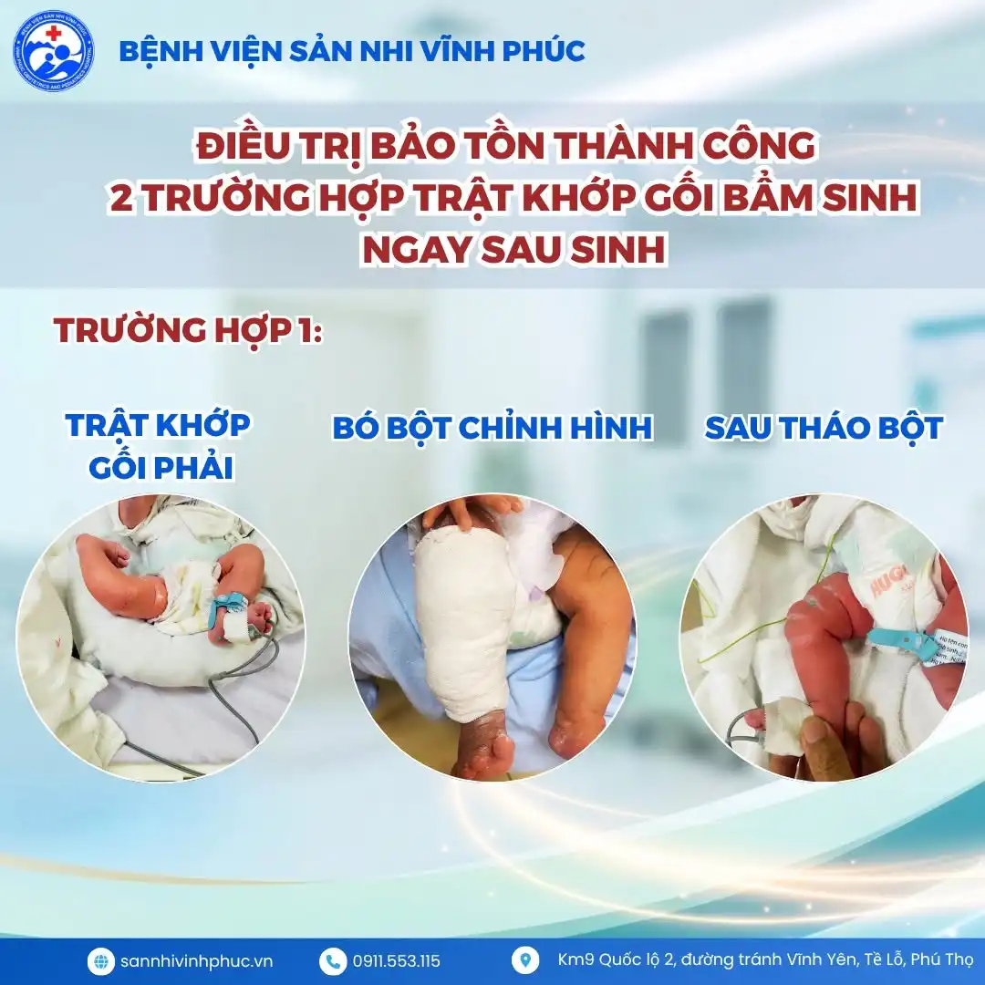 Phát hiện sớm 02 trường hợp trật khớp gối bẩm sinh ngay sau sinh - Điều trị bảo tồn thành công tại Bệnh viện Sản Nhi Vĩnh Phúc 1 Trường hợp 1