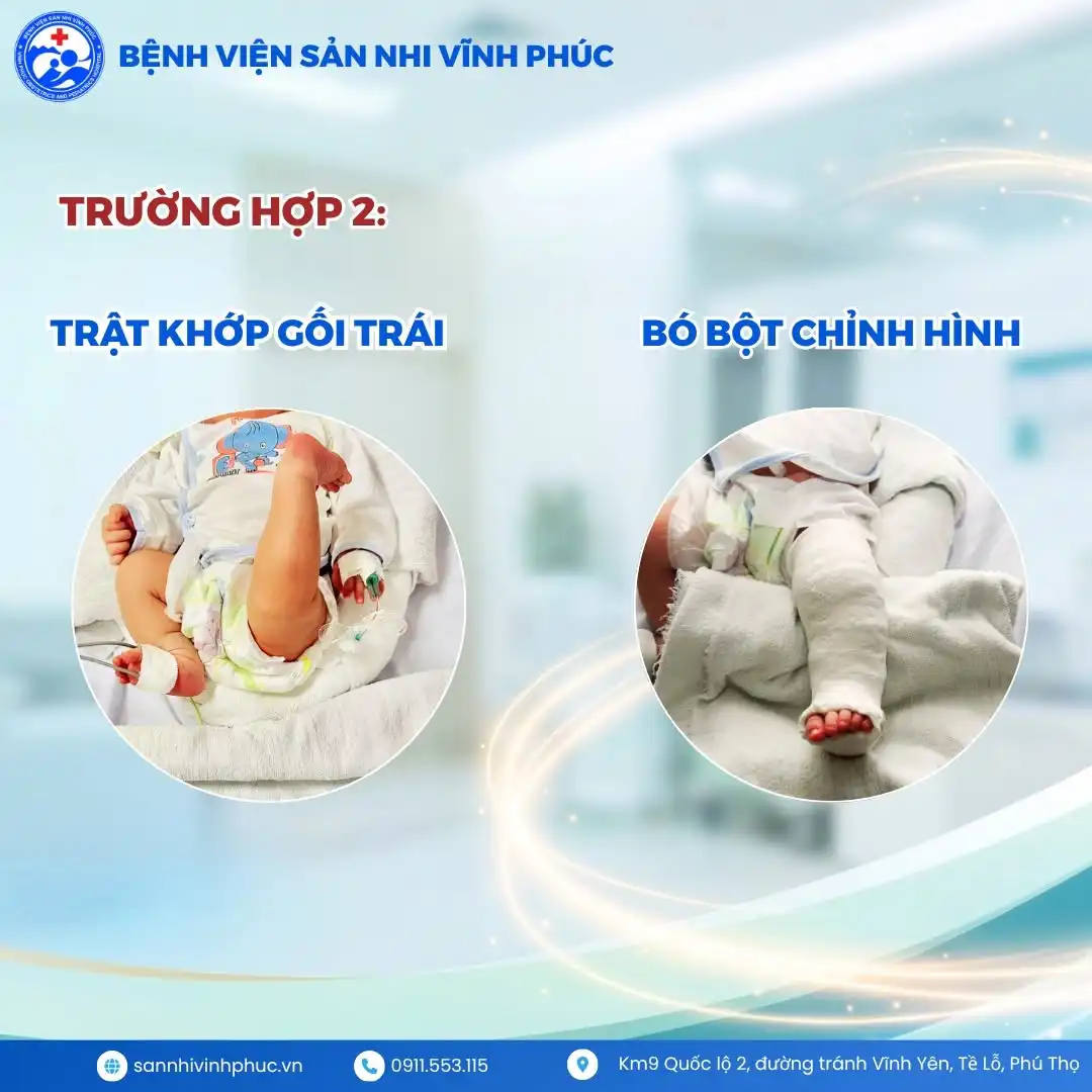 Phát hiện sớm 02 trường hợp trật khớp gối bẩm sinh ngay sau sinh - Điều trị bảo tồn thành công tại Bệnh viện Sản Nhi Vĩnh Phúc 2 Trường hợp 2