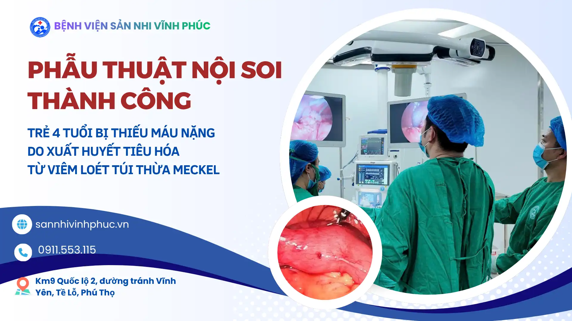 Phẫu thuật nội soi thành công cho bệnh nhi 4 tuổi bị thiếu máu nặng do xuất huyết tiêu hóa từ viêm loét túi thừa Meckel 1 Phẫu thuật nội soi thành công cho bệnh nhi 4 tuổi bị thiếu máu nặng do xuất huyết tiêu hóa từ viêm loét túi thừa Meckel