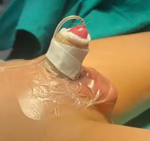 Lỗ tiểu lệch thấp ở trẻ em: Phát hiện sớm để điều trị hiệu quả 3 Hình ảnh sau phẫu thuật 1 TH lỗ tiểu lệch thấp (Nguồn ảnh: Khoa Ngoại tổng hợp BVSNVP)