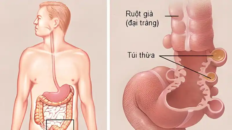 Phẫu thuật nội soi thành công cho bệnh nhi 4 tuổi bị thiếu máu nặng do xuất huyết tiêu hóa từ viêm loét túi thừa Meckel 2 Túi thừa meckel (Hình ảnh minh họa _Nguồn internet)