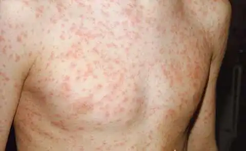 Rubella: Dấu hiệu, đường lây và cách phòng bệnh 2 Hình ảnh minh họa ban trên người bệnh mắc Rubella